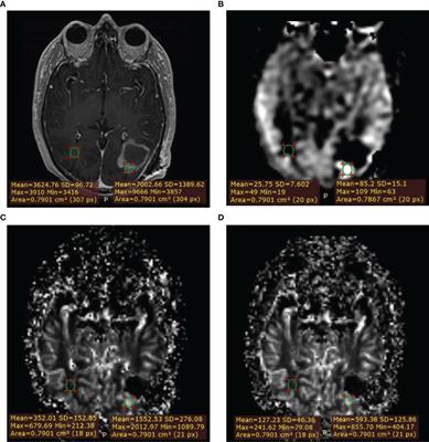 Diagnostic Accuracy of Arterial Spin Labeling in Comparison With Dynamic Susceptibility Contrast-Enhanced Perfusion for Brain Tumor Surveillance at 3T MRI